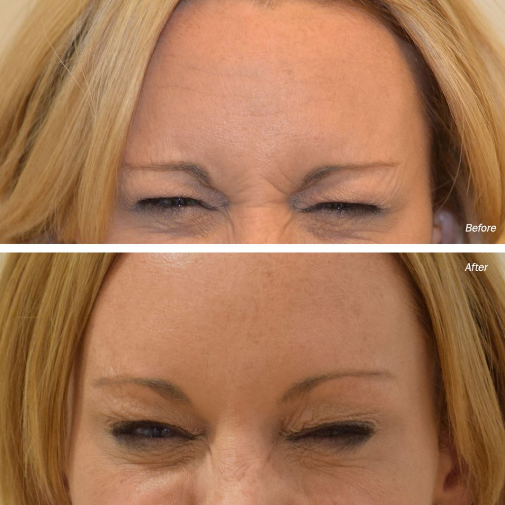Lip Fillers, Dermal Fillers Manchester, Leeds | Botox Manchester, Leeds ...