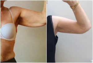 arm-lift-before-after-fallahdar-the-private-clinic