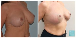 auto breast augmentation implant removal natural breast lift before after photo