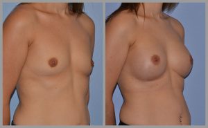 before after photos breast implants
