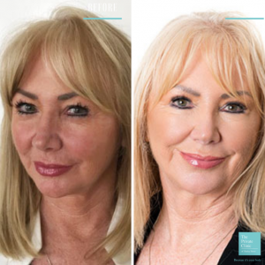 upper blepharoplasty eyelid surgery before and after photo
