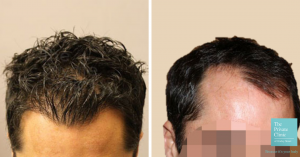 hair transplant left right temporal recession before after photo