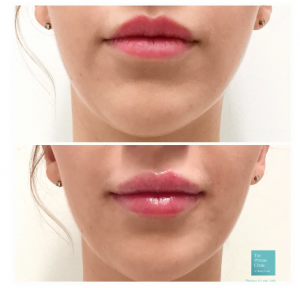 lip fillers before after photo