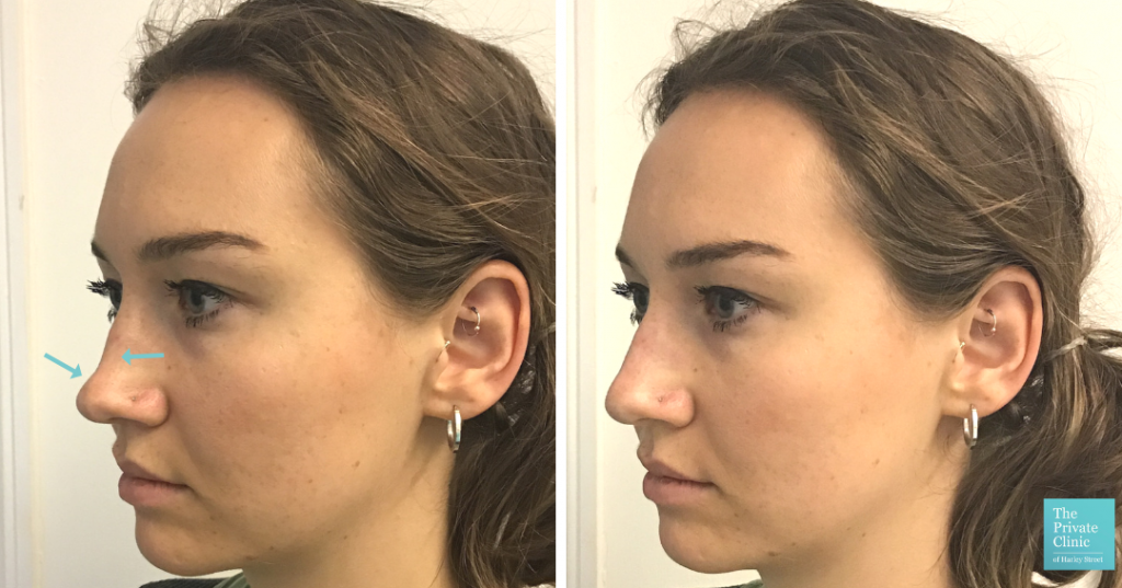 non surgical nose job rhinoplasty before after photo