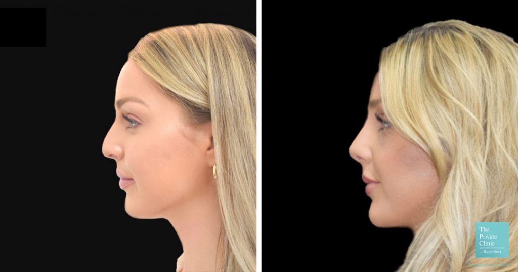 rhinoplasty before and after uk