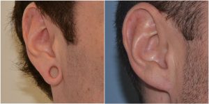 tribal ear correction before after photo