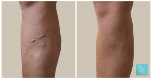 varicose vein removal EVLA treatment before and after photo 