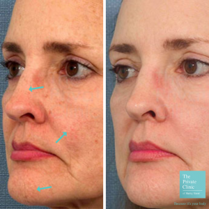 ipl face treatment before and after