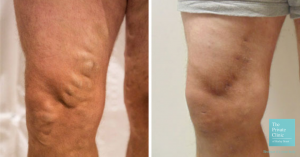 varicose vein removal EVLA procedure before and after