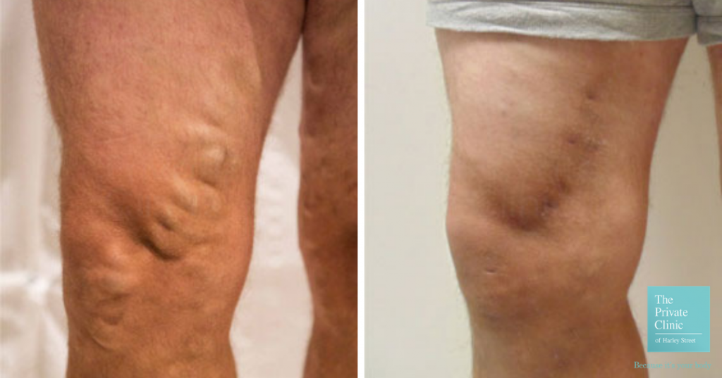 leg veins before and after EVLA procedure