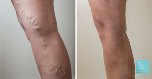 varicose vein removal treatment before and after photo