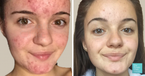 before and after acne treatment n-lite