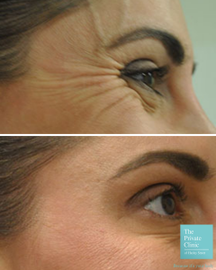 crows feet wrinkle injections before and after photo