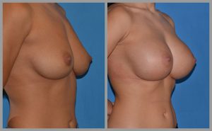 before and after breast implants augmentation pictures