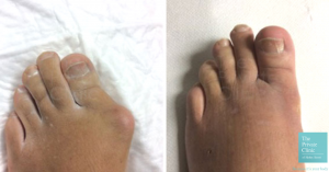 bunion surgery uk before and after photo