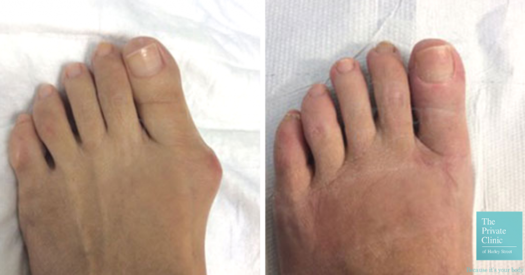 bunion correction treatment before and after photo