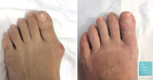 Before and after minimally invasive bunion treatment