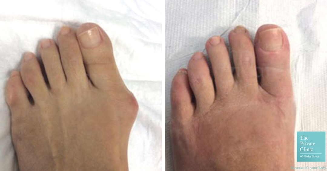 Before and after mini-invasive bunion removal surgery. 