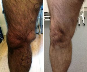 Before and After ELVA varicose veins glasgow