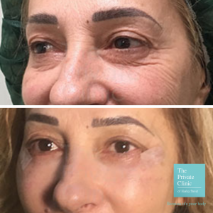 Before and after a lower eyelid blepharoplasty.