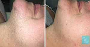 facial laser hair removal before and after photo