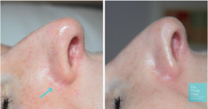 Before and after Cutera CoolGlide for facial veins.