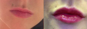 Before and after fillers used to add volume and shape to the lips. 