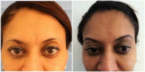 before and after fue eyebrow hair transplant at the private clinic of harley street