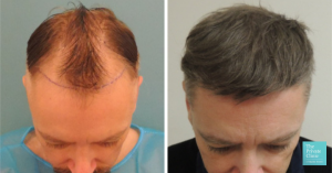 hair transplant frot top crown area before and after photo