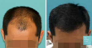 Before and after of FUE Hair Transplant by Dr Raghu Reddy