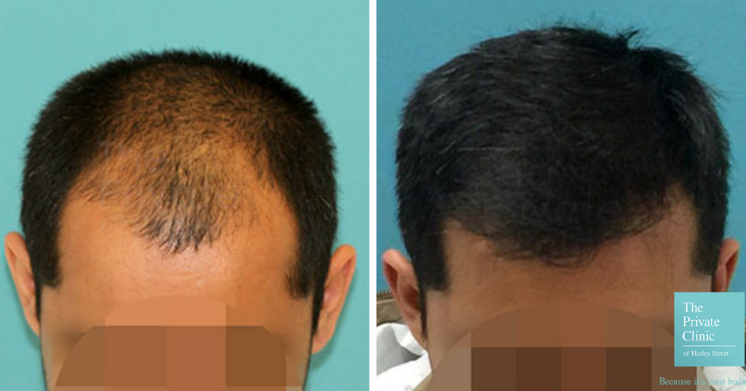 Hair Transplant London at Harley Street Private Hair Clinic, FUE Hair Transplantation Hair Transplant London at Harley Street Private Hair Clinic, FUE Hair Transplantation