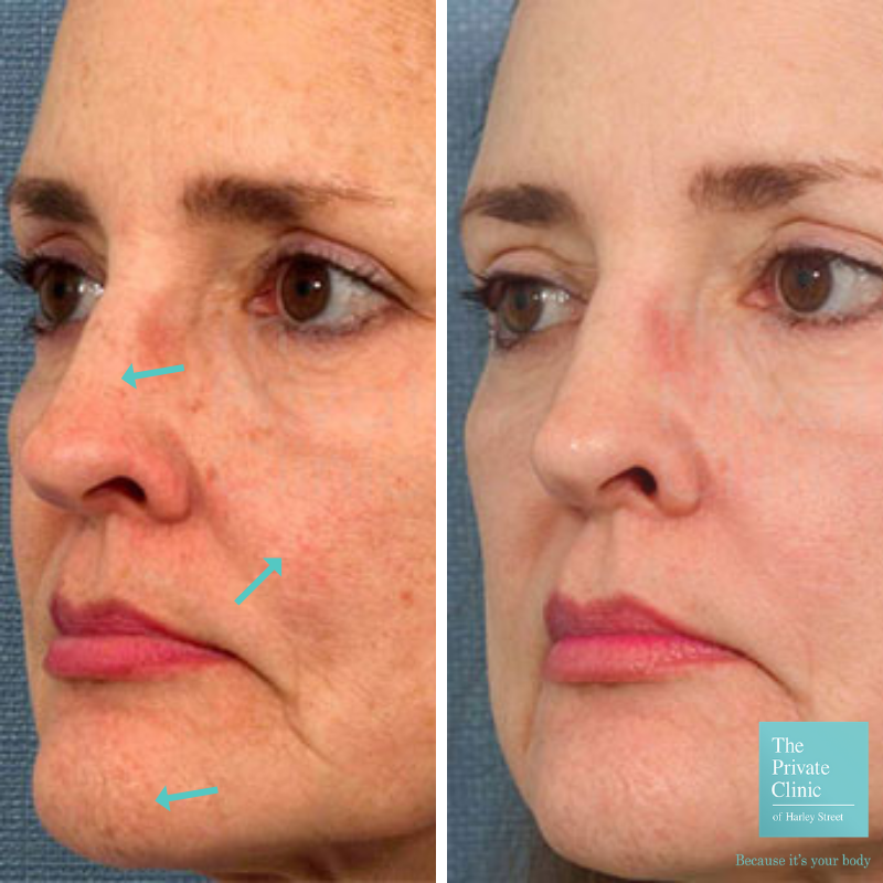 IPL Photorejuvenation face treatment before after photo