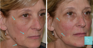 non surgical facelift before and after photo