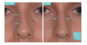 Before and after non-surgical rhinoplasty photo