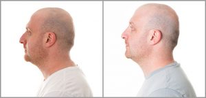 male rhinoplasty before and after photo london