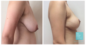 Before and after picture of a breast reduction from the side