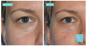 tear trough filler before and after photo