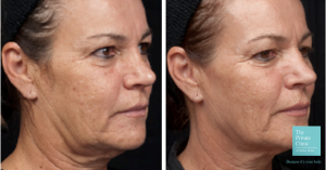 before and after thermage treatment