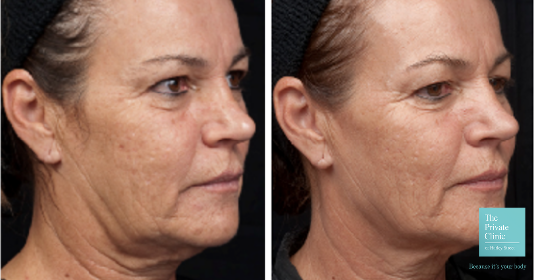 thermage before and after photo