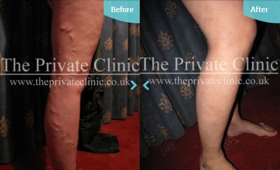 Before and after Varicose Vein treatment at The Private Clinic.