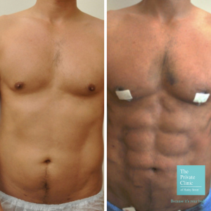 Vaser Liposuction High-Def before and after results