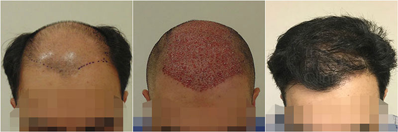 hair transplant before after photo results