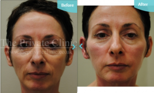 fat transfer to the face before and after photo
