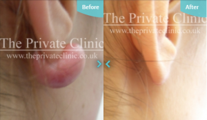 An example of keloid scar excision, performed at The Private Clinic