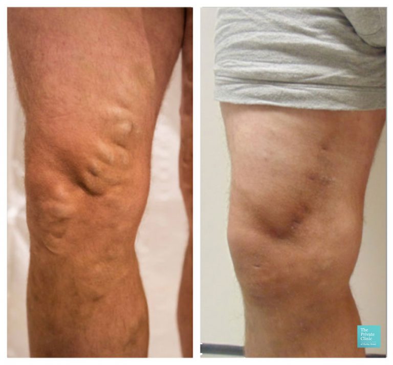 Varicose veins treatment recovery, Varicose vein laser surgery recovery