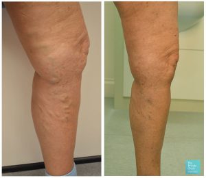 EVLA and Phlebectomy treatment before and after photo