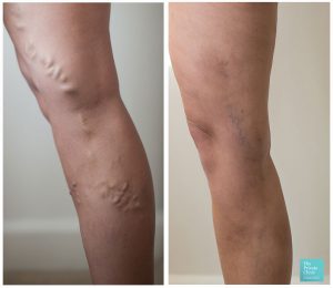 varicose vein evla treatment before after photo results