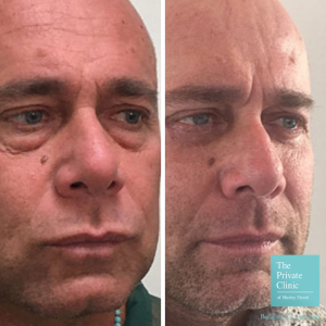 lower blepharoplasty before and after photo