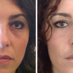 Blepharoplasty Eyelid Surgery before and after photo