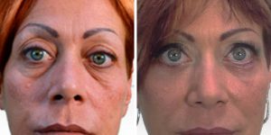 blepharoplasty before and after photos